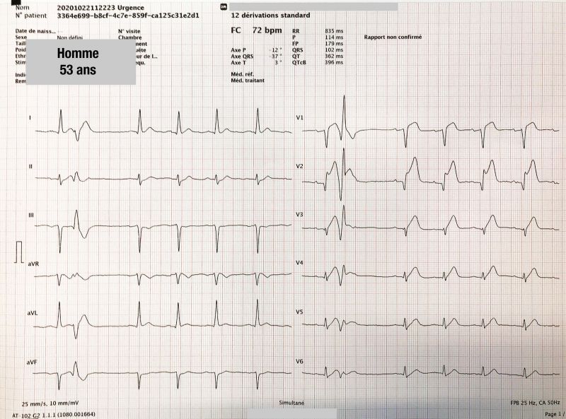 Fichier:ECG STEMI.jpg