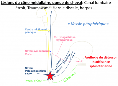 Aréflexie sphinctérienne.png