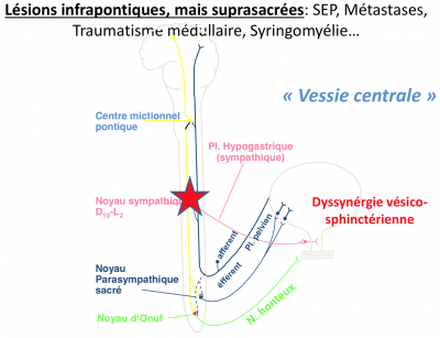 Dyssynergie vésicosphinctérienne.png