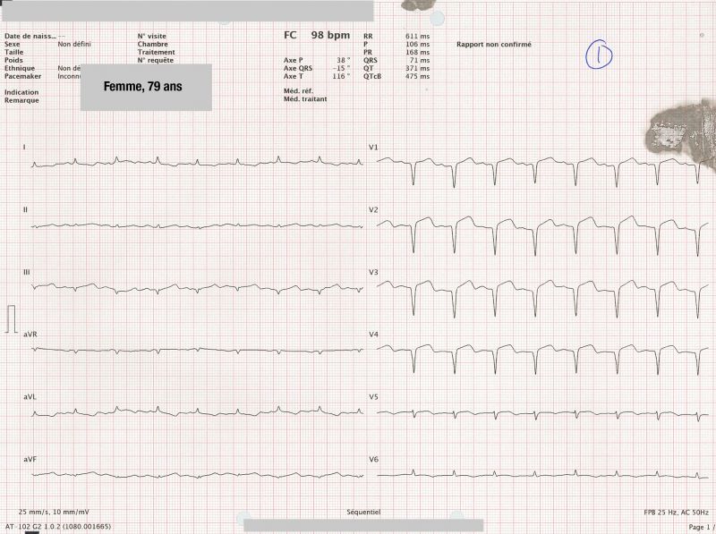 Fichier:ECG X.jpg