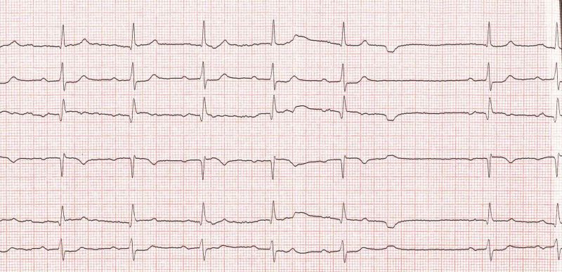 Fichier:ECG Maladie du sinus.jpg