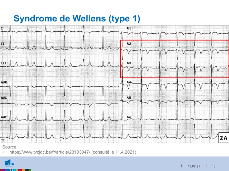 Fichier:2021-05-05 Equivalents STEMI.pdf