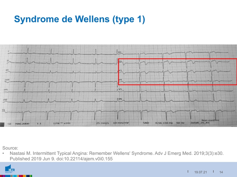 Fichier:2021-05-05 Equivalents STEMI.pdf