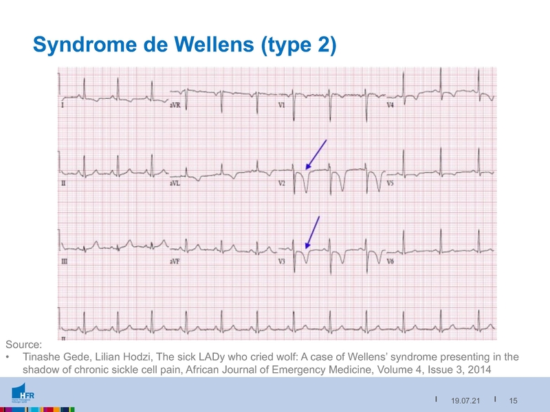 Fichier:2021-05-05 Equivalents STEMI.pdf