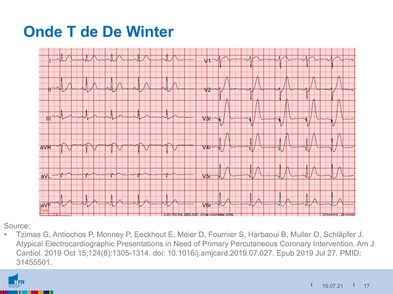 Fichier:2021-05-05 Equivalents STEMI.pdf
