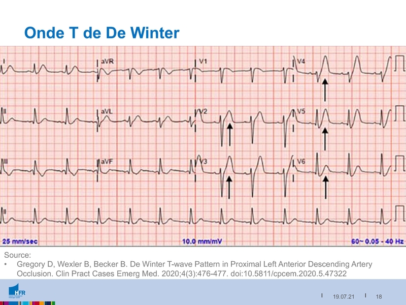 Fichier:2021-05-05 Equivalents STEMI.pdf