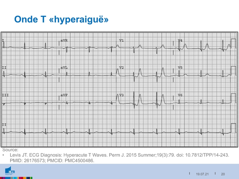 Fichier:2021-05-05 Equivalents STEMI.pdf