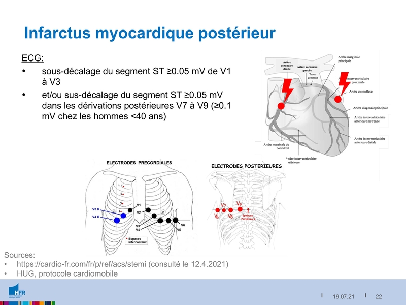Fichier:2021-05-05 Equivalents STEMI.pdf