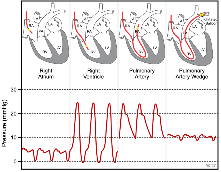 Fichier:Swan-ganz-pressures.png