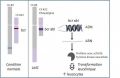 Gène de fusion bcr-abl, chromosome de Philadelphie.jpg