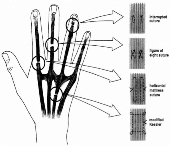 Fichier:Extenseurs lesions.png