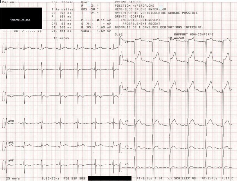 Fichier:ECG HVG.png