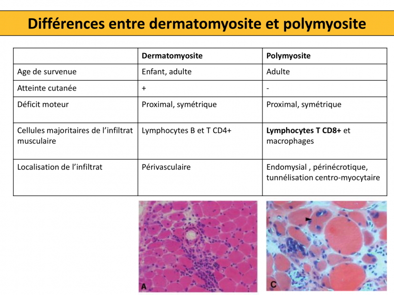 Fichier:Polymyosite et dermatomyosite.png