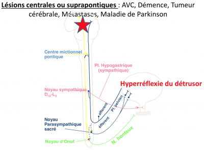 Hyperréflexie vésicale.png