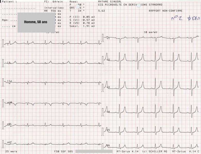 Fichier:ECG Hyperkaliémie.jpg