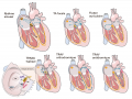 Tachycardies supraventriculaires.png