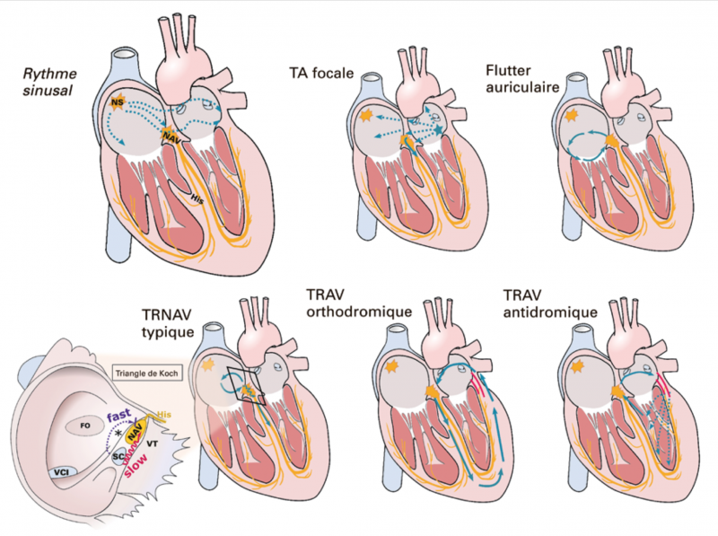 Fichier:Tachycardies supraventriculaires.png
